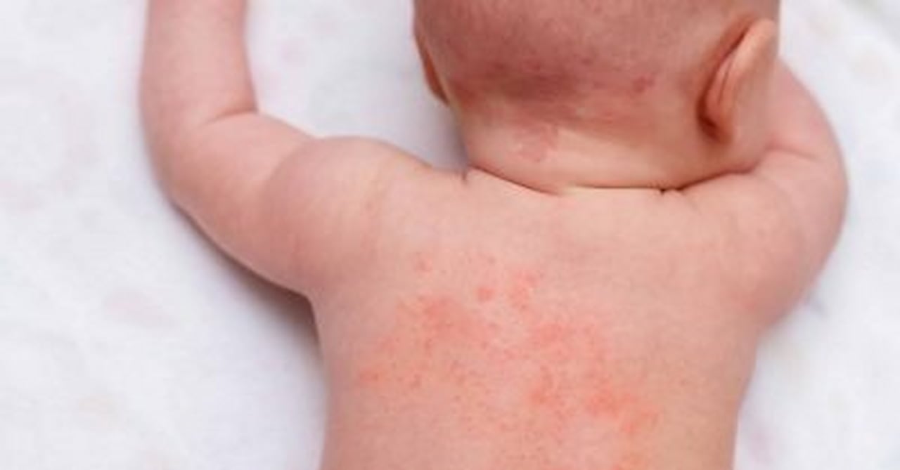 Increase in skin diseases among children; don’t fear to bathe them: Pediatrician