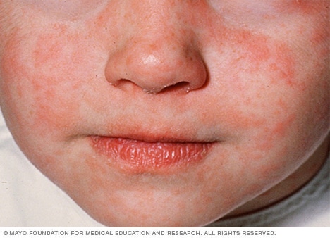 Measles shows an increase among those unvaccinated: Paediatrician