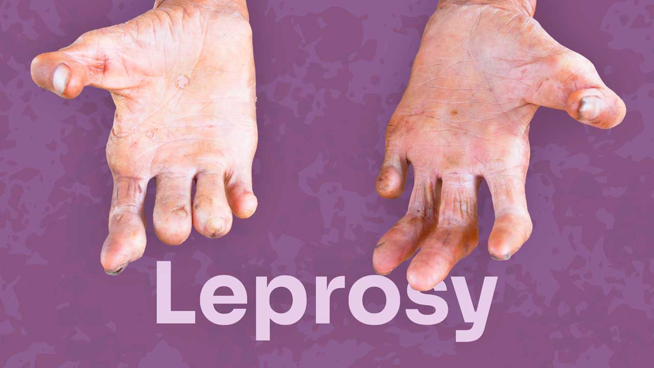 264 new leprosy patients identified in Sri Lanka so far this year