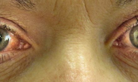 5% of country’s population suffering from glaucoma – Health Secretary